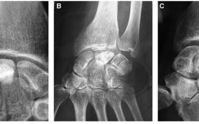 Doença de Kienböck (Necrose avascular do osso Semilunar)