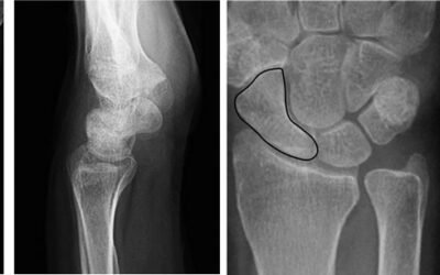 Doença de Preiser (Necrose avascular do osso Escafóide)