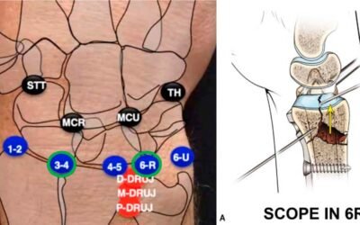 Artroscopia nas fraturas do punho